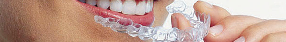 Straightening Teeth, Tooth and Dental Brace services in South Shields, Boldon, Seaburn, Sunderland, Fulwell, Peterlee